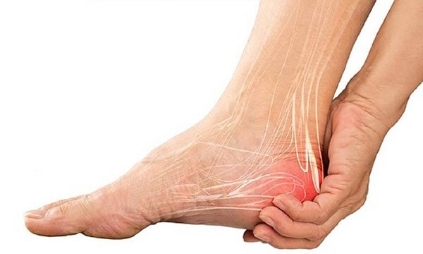 Gai gót chân – nguyên nhân và cách điều trị